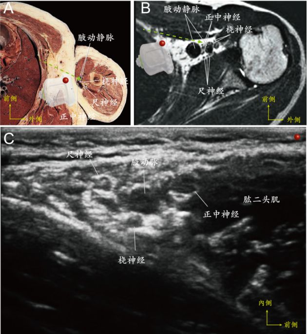 超声引导外周神经快速识别技术及超声图像采集指南（上海交通大学医学院附属第六人民医院）(图3)