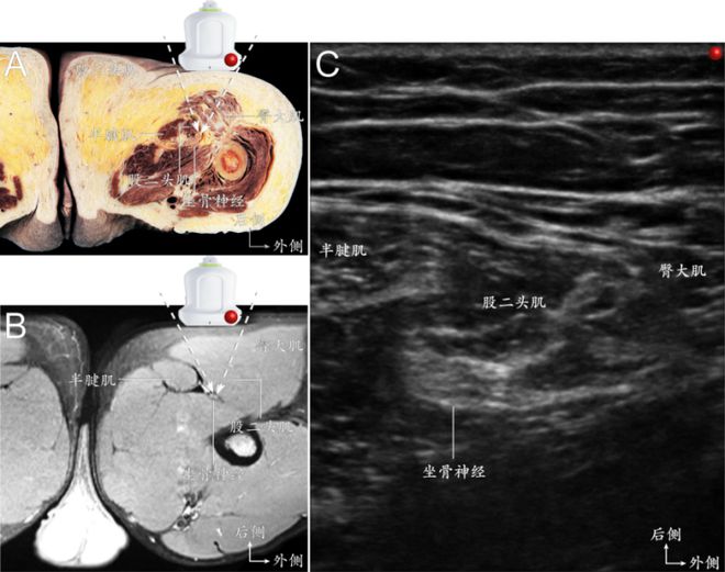 超声引导外周神经快速识别技术及超声图像采集指南（上海交通大学医学院附属第六人民医院）(图5)