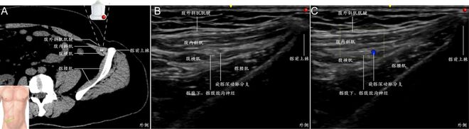 超声引导外周神经快速识别技术及超声图像采集指南（上海交通大学医学院附属第六人民医院）(图9)